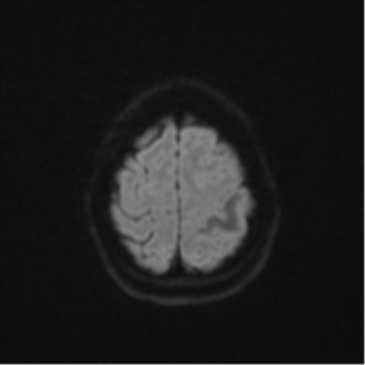 File:Cerebral metastasis (Radiopaedia 46744-51248 Axial DWI 52).png