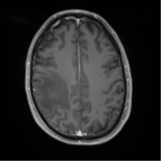 Cerebral metastasis - melanoma (Radiopaedia 54718-60954 Axial T1 C+ fat sat 38).png