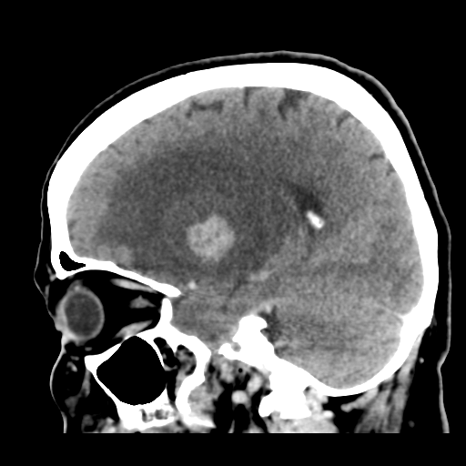 Cerebral metastasis to basal ganglia (Radiopaedia 81568-95412 Sagittal C+ delayed 22).png