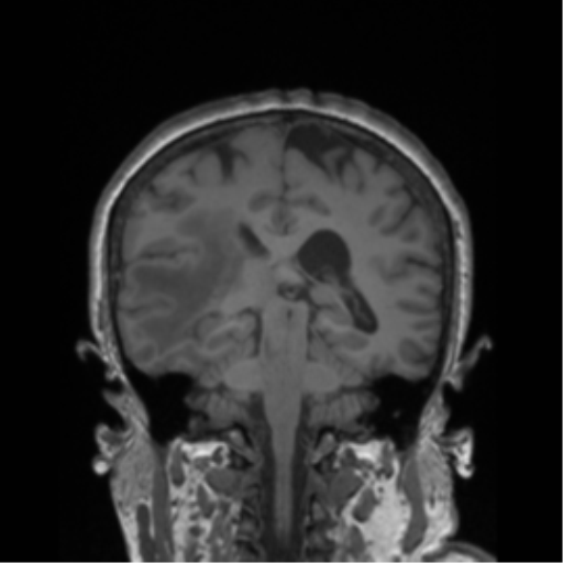 Cerebral metastasis to basal ganglia (Radiopaedia 81568-95413 Coronal T1 17).png