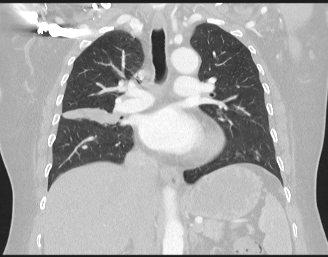 Cerebral metastasis to basal ganglia (Radiopaedia 81568-95414 Coronal lung window 46).png