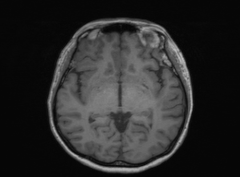 Cerebral ring enhancing lesions - cerebral metastases (Radiopaedia 44922-48817 Axial T1 239).jpg