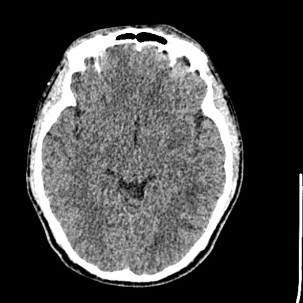 File:Cerebral toxoplasmosis (Radiopaedia 53993-60131 Axial non-contrast 36).jpg