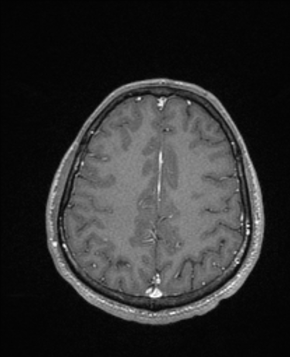 Cerebral toxoplasmosis (Radiopaedia 85779-101597 Axial T1 C+ 122).jpg