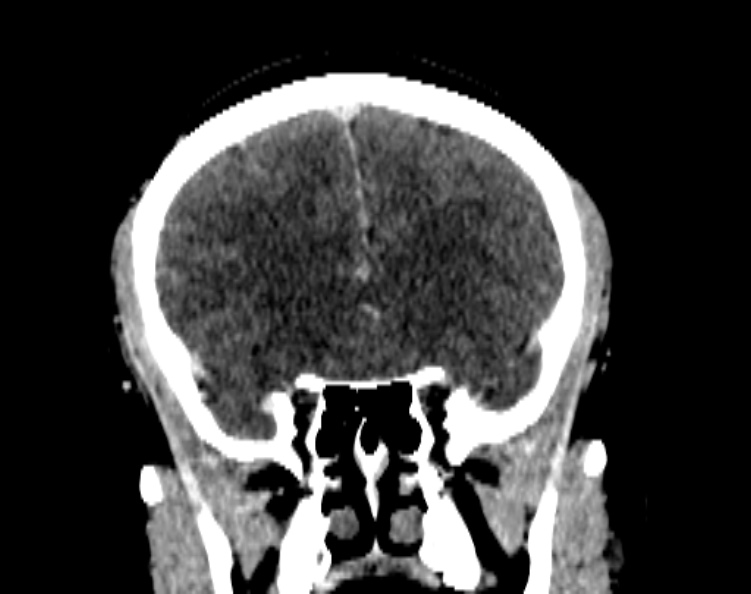 Cerebral venous hemorrhagic infarct from venous sinus thrombosis (Radiopaedia 55433-61883 Coronal C+ delayed 24).jpg