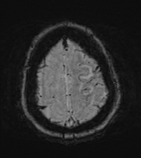 Cerebral venous infarct (Radiopaedia 53627-59685 Axial SWI 48).jpg