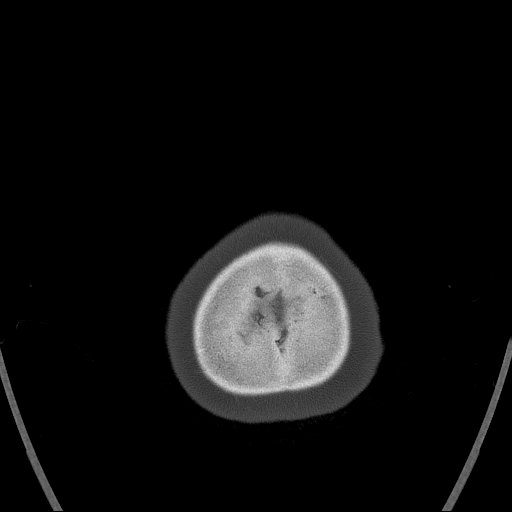 Cerebral venous infarction with hemorrhage (Radiopaedia 65343-74381 Axial bone window 191).jpg