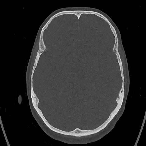 Cerebral venous infarction with hemorrhage (Radiopaedia 65343-74381 Axial bone window 58).jpg