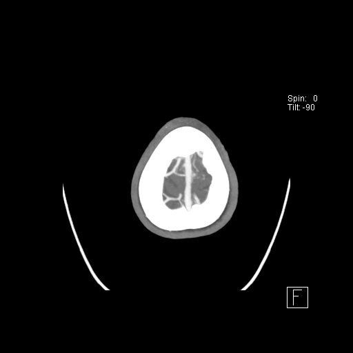 Cerebral venous infarction with hemorrhage (Radiopaedia 65343-74396 A 133).jpg