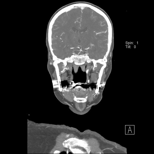Cerebral venous infarction with hemorrhage (Radiopaedia 65343-74396 B 154).jpg