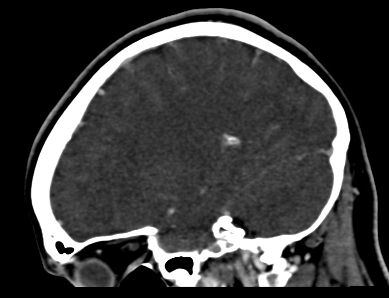Cerebral venous sinus thrombosis (Radiopaedia 59224-66646 Sagittal C+ delayed 9).jpg