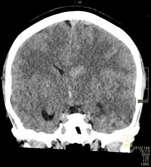 Cerebral venous sinus thrombosis (Radiopaedia 91329-108965 Coronal non-contrast 27).jpg