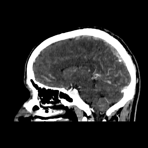 File:Cerebral venous thrombosis (CVT) (Radiopaedia 77524-89685 Sagittal CTV 25).jpg
