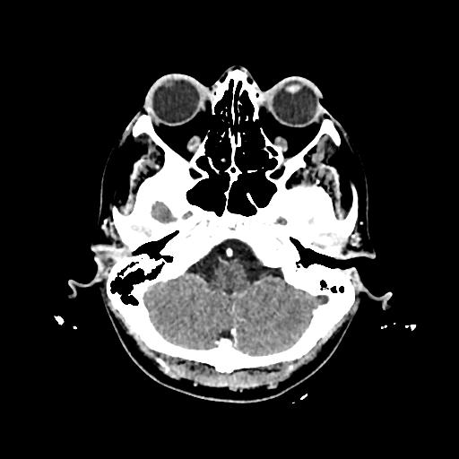 File:Cerebral venous thrombosis with venous hemorrhagic infarct (Radiopaedia 90354-107660 Axial with contrast 34).jpg