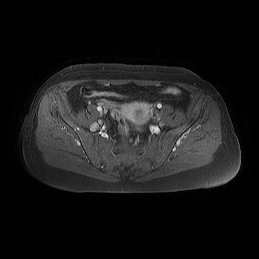 File:Cervical carcinoma (Radiopaedia 67644-77047 Axial T1 C+ fat sat 8).jpg