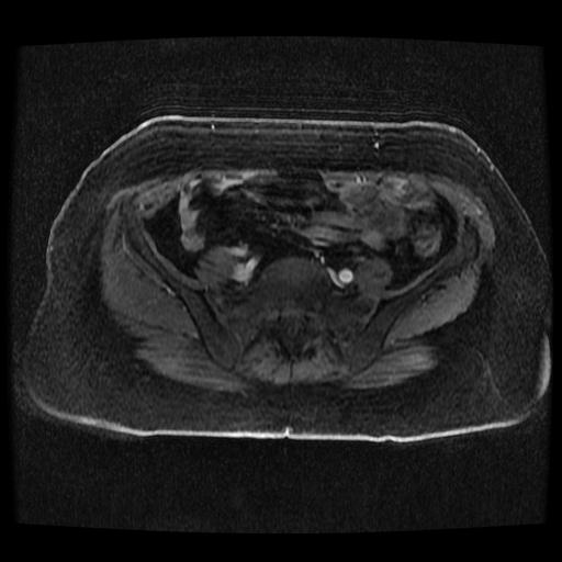 Cervical carcinoma (Radiopaedia 70924-81132 Axial T1 C+ fat sat 163).jpg