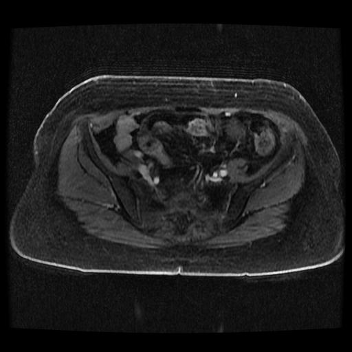 Cervical carcinoma (Radiopaedia 70924-81132 Axial T1 C+ fat sat 245).jpg