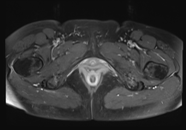 File:Cervical carcinoma (Radiopaedia 88312-104943 Axial T1 C+ fat sat 20).jpg