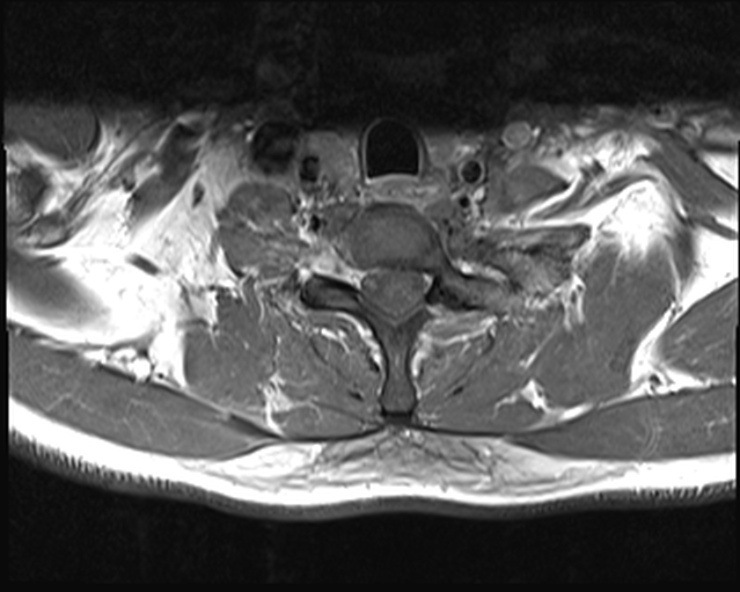 File:Cervical disc extrusion (Radiopaedia 53950-60077 Axial T1 C+ fat sat 25).jpg