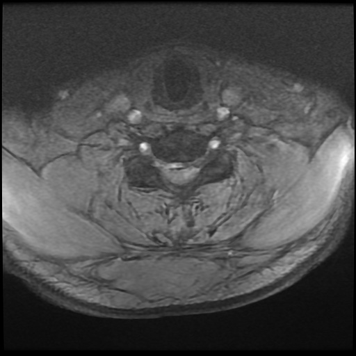 Cervical disc extrusion (Radiopaedia 59074-66364 F 40).jpg