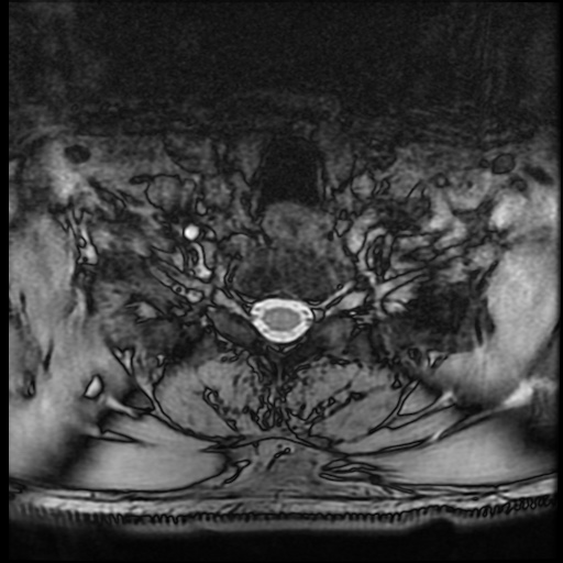 Cervical disc extrusion (Radiopaedia 59074-66364 G 97).jpg