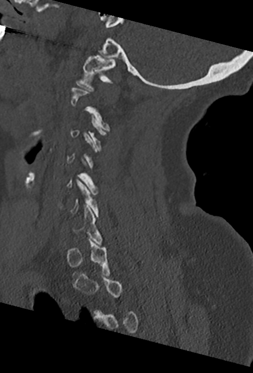Cervical spine ACDF loosening (Radiopaedia 48998-54070 Sagittal bone window 60).png
