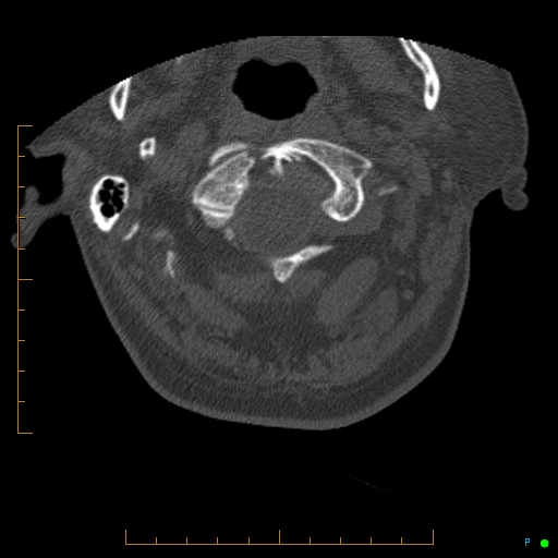 Cervical spine fracture - ankylosing spondylitis (Radiopaedia 76835-88706 Axial bone window 19).jpg