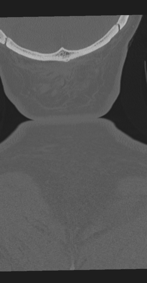 Cervical spine fracture in the setting of ankylosis (Radiopaedia 37038-38715 Coronal bone window 77).png