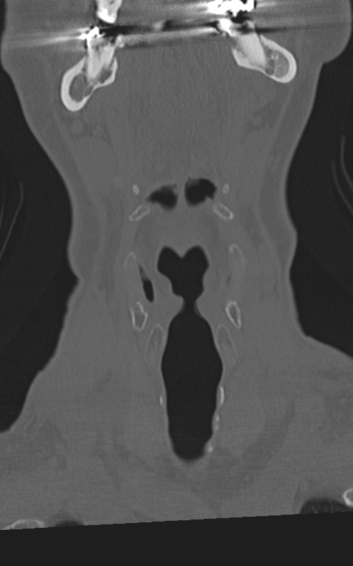 Cervical spine fractures with vertebral artery dissection (Radiopaedia 53296-59268 Coronal bone window 2).png