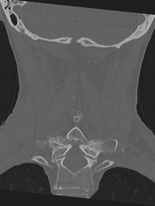 Cervical spondylolysis (Radiopaedia 49616-54811 Coronal bone window 39).png