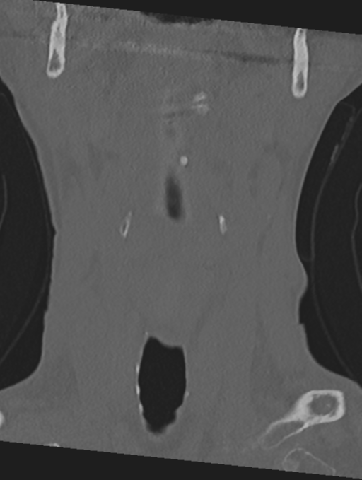 Cervical spondylolysis (Radiopaedia 49616-54811 Coronal bone window 5).png