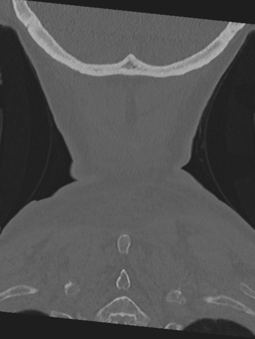 Cervical spondylolysis (Radiopaedia 49616-54811 Coronal bone window 60).png