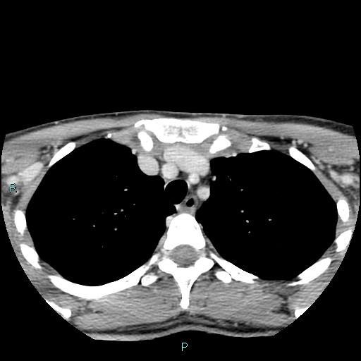 Cervical thymic cyst (Radiopaedia 88632-105335 C 10).jpg