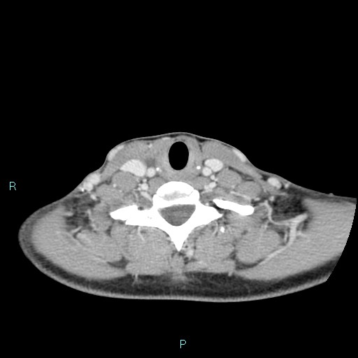 Cervical thymic cyst (Radiopaedia 88632-105335 C 42).jpg