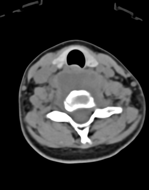 Cervical tuberculous spondylitis (Radiopaedia 39149-41365 Axial non-contrast 37).png