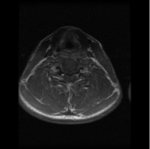 File:Cervical vertebrae metastasis (Radiopaedia 78814-91667 Axial T1 C+ 7).png