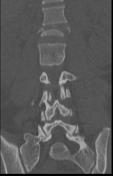 File:Chance fracture (Radiopaedia 11293-11657 Coronal bone window 1).jpg