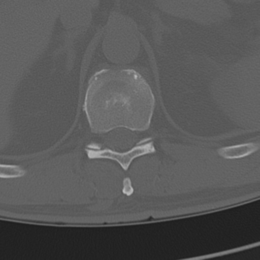 Chance fracture (Radiopaedia 33854-35020 Axial bone window 81).png