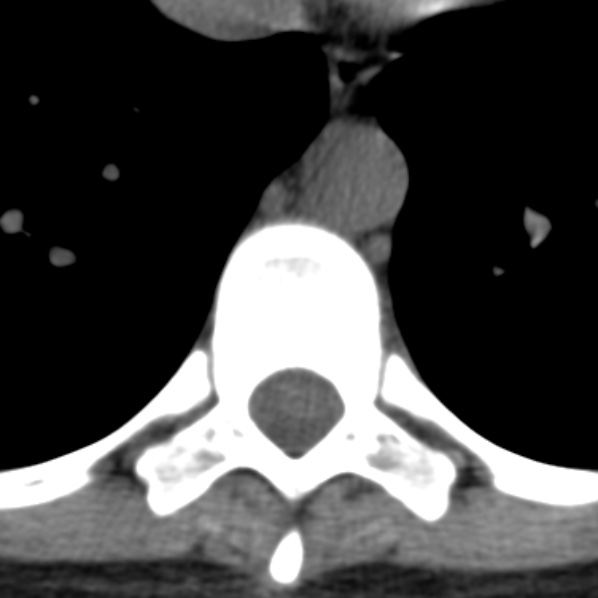 File:Chance fracture (Radiopaedia 36521-38081 Axial non-contrast 27).jpg