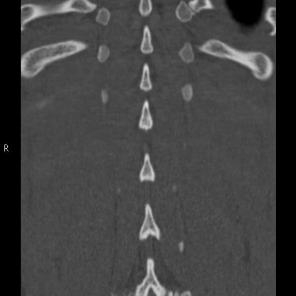 Chance fracture (Radiopaedia 36521-38081 Coronal bone window 56).jpg