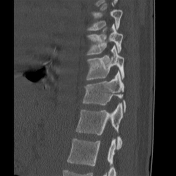 Chance fracture (Radiopaedia 36521-38081 Sagittal bone window 47).jpg