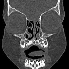 Choanal atresia (Radiopaedia 88525-105975 Coronal bone window 11).jpg
