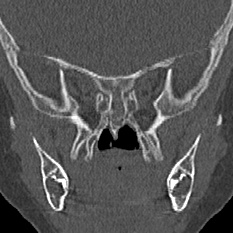 Choanal atresia (Radiopaedia 88525-105975 Coronal bone window 75).jpg