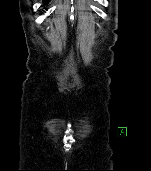 Cholangiocarcinoma with cerebral metastases (Radiopaedia 83519-98629 G 79).jpg