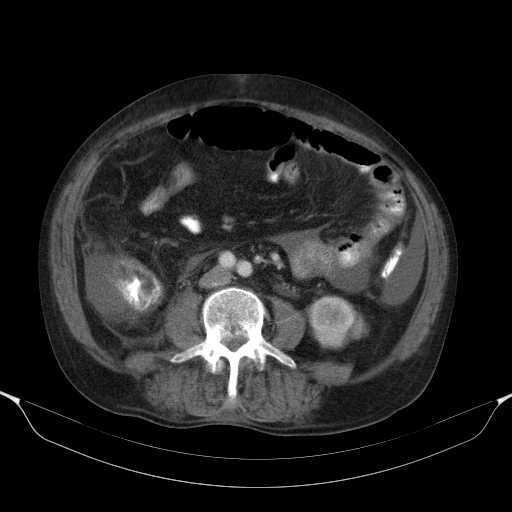 File:Cholangitis and abscess formation in a patient with cholangiocarcinoma (Radiopaedia 21194-21100 A 29).jpg