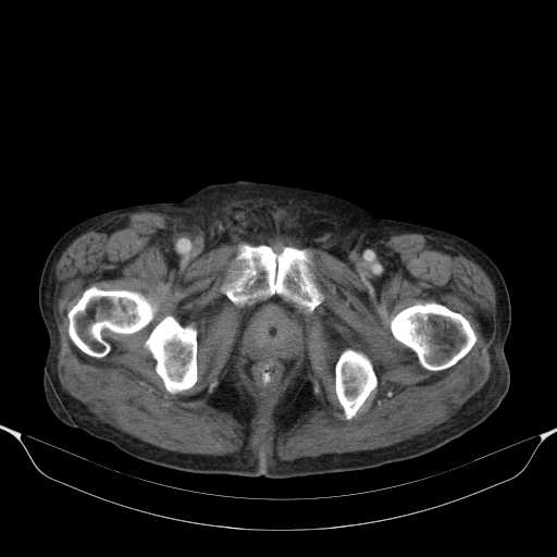 File:Cholangitis and abscess formation in a patient with cholangiocarcinoma (Radiopaedia 21194-21100 A 50).jpg