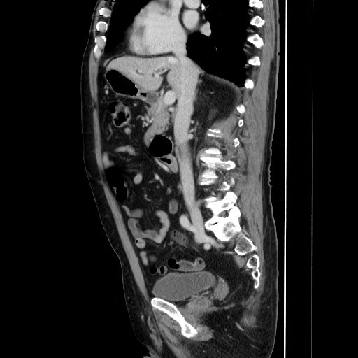 Choledocholiathiasis with normal caliber common bile duct (Radiopaedia 75368-86632 D 74).jpg