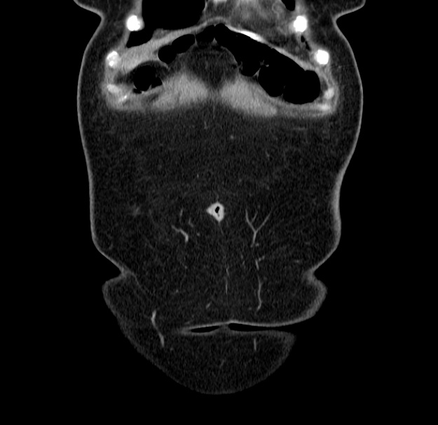 Choledocholithiasis on CT and MRI (Radiopaedia 24825-25087 C 5).jpg