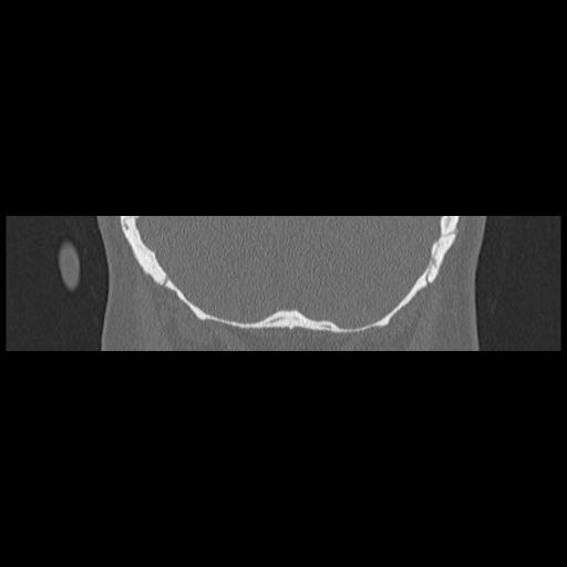 Cholesteatoma (Radiopaedia 84946-100455 Coronal bone window 134).jpg
