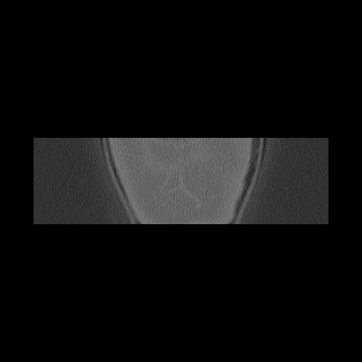 Cholesteatoma (Radiopaedia 84946-100455 Coronal bone window 175).jpg